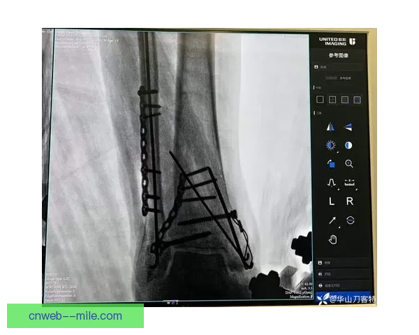科尔十字韧带断裂后艰难康复之路 逆袭重生的体育精神与毅力